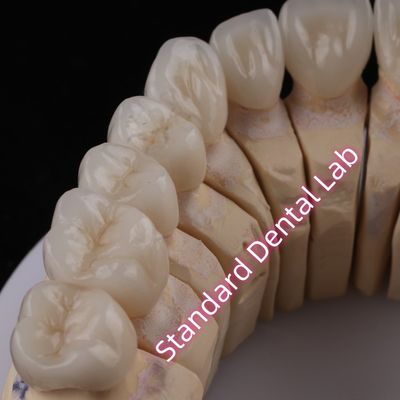 comprar Laboratório Dental CAD CAM Digital PFZ Coroas Translúcidas Coroa de Zircônio em Camadas fabricação em linha