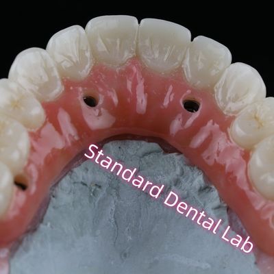 comprar Implante Dental Coroa PFZ Porcelana em camadas Zirconia parafuso retido com goma rosa fabricação em linha