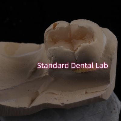 comprar Inlação Dental de Porcelana Fundida Onlay Overlay Zirconia Emax Alta Estética fabricação em linha