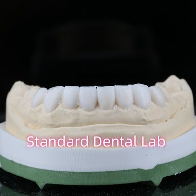 comprar Diagnóstico Restauração Odontologia Ventola Veneers Alta Estética fabricação em linha