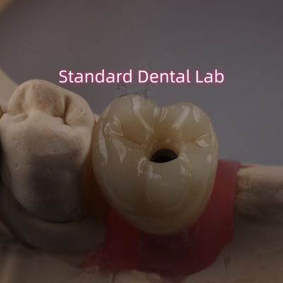 comprar Implantação dental retida por parafuso coroa PFZ porcelana em camadas de zircônio fabricação em linha