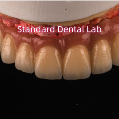 comprar PFM Digital Coroas de porcelana de metais não preciosos Ponte Alta estética Natural fabricação em linha