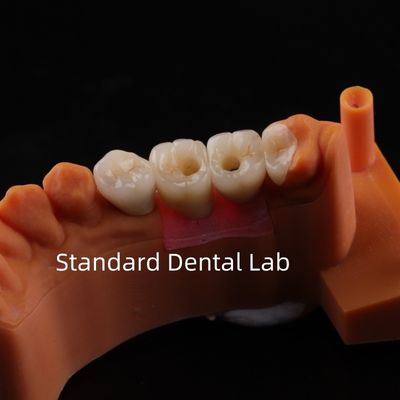 comprar Porcelana Zirconia Implantação Dental Ponte Profissional Alta Estética fabricação em linha
