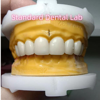 comprar Veneers de coroa de zircônio Ivoclar Alta translucidez Estética fabricação em linha