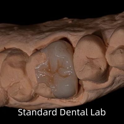 comprar Translucidez Emax Zirconia Dental Inlay Onlay Coroa Para Restaurar a Forma Natural da Cavidade fabricação em linha