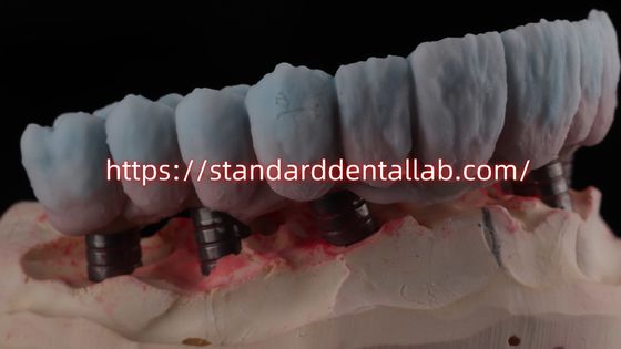 comprar Ponte de zircônio suportado por implante com abutment de titânio de alta estética fabricação em linha