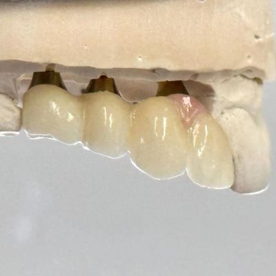 comprar Implante de parafuso retido de cimento de zircônio de porcelana Forma de cabeça hexagonal para estética personalizada fabricação em linha