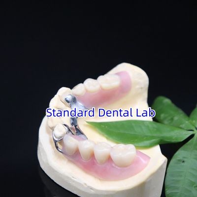 comprar Quadros de dentaduras parciais de metal acrílico Alta estética Laboratório odontológico SDL fabricação em linha