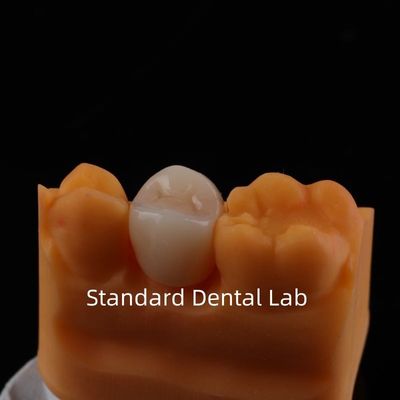 comprar Coroa de contorno completo de zircônio Força e estética excepcionais Sem revestimento de porcelana Coroa posterior China Laboratório dentário fabricação em linha