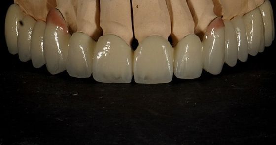 comprar Bom ajuste Boa estética Coroa de zircônio multicamadas Porcelana Ponte de zircônio fabricação em linha