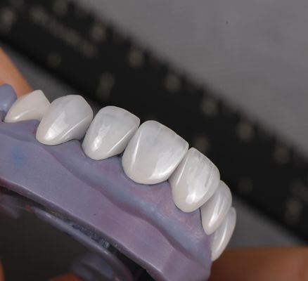 comprar Emax Veneers de aparência natural Biocompatibilidade da coroa Branqueamento de sombra com preparação mínima fabricação em linha