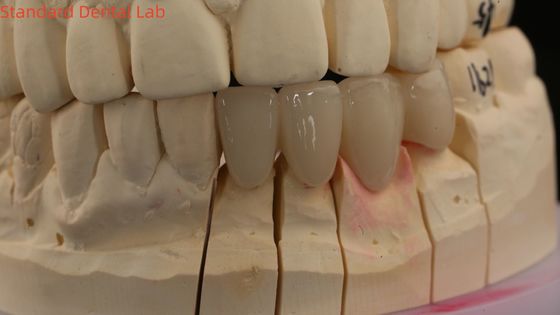 comprar Coroas de laboratório dentário sólido 3D Pro de alta translucidez Coroas de zircônio completo com sombra Vita personalizado fabricação em linha