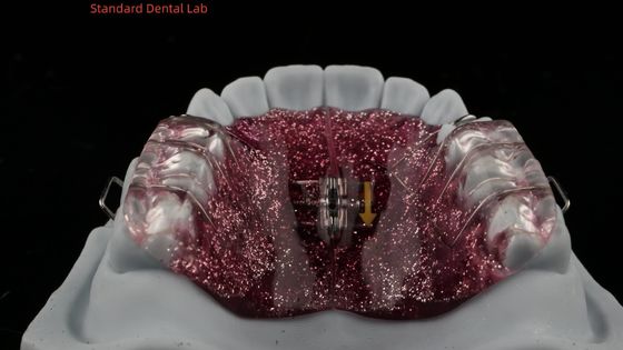 comprar Expansão e Distalação dos Dentes Expandidor de Ajuste na Boca Ortodontista Expansor do Palato fabricação em linha