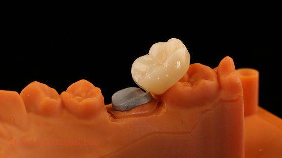 comprar Alta estética coroa de zircônio de contorno completo com núcleo de poste de metal 5 anos de garantia e melhores técnicos do SDL Dental Lab fabricação em linha