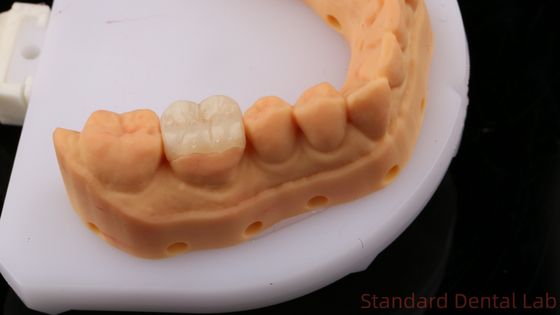 comprar Translúcido Zirconia Dental Inlay Onlay Coroa Para Restaurar a Forma Natural da Cavidade / Laboratório Dental Padrão fabricação em linha
