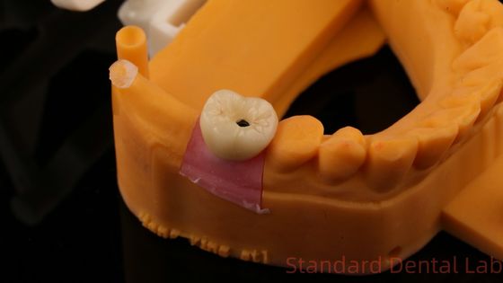 comprar Parafuso de implante dentário coroa retida PFZ porcelana em camadas de zircônio com modelo de impressão 3D fabricação em linha