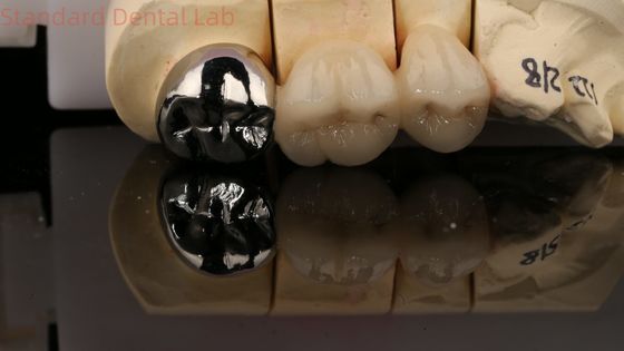 comprar Coroa de porcelana Vita de metal completo com post core 3 anos de garantia do laboratório dentário fabricação em linha