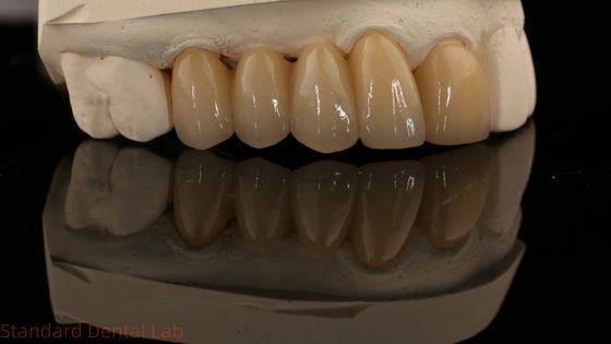 comprar Noritake Porcelana de contorno completo Coroa de zircônio de alta estética Natural Ponte Dental de zircônio personalizada fabricação em linha