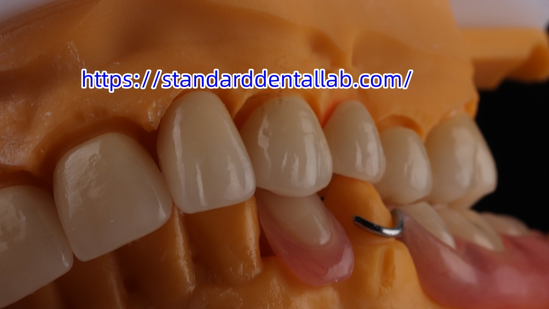 Layered Zirconia Crown