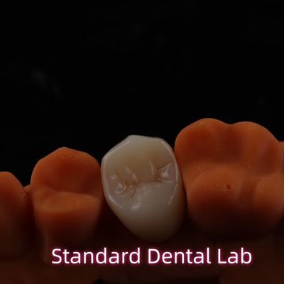 BruxZir de Alto Estética de Conto Completo Coroas de Zirconia Ponte PFZ