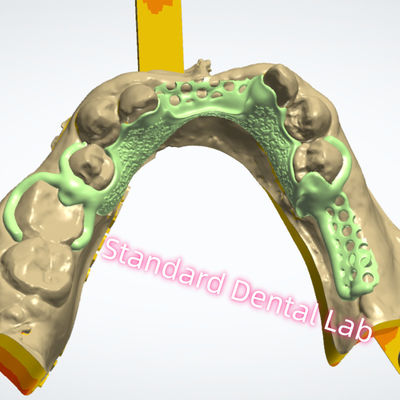 Projeto de estrutura metálica Impressão a laser Cromo fundido Dentadura parcial Ni Be Free