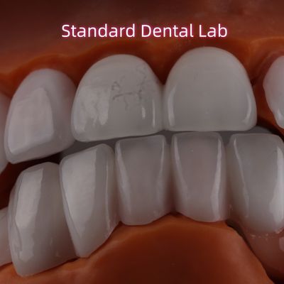 Litio Dicilicate camada Ivoclar Emax Zirconia Laminate Veneers Translúcido OEM ODM