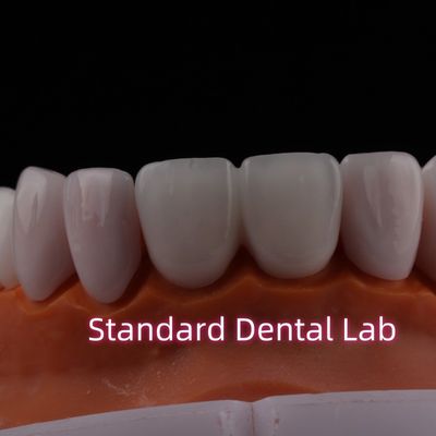 Translúcidas Emax Zirconia Laminado Veneers Porcelana Veneers Dentários Químicamente Verystable
