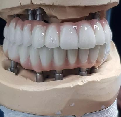 Cimento de parafuso de implantes de zircônio de fabricação precisa, retido para dentes de aparência natural