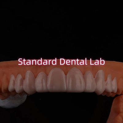 Aplicação de revestimentos de sorriso para descolorações / lacunas nos dentes