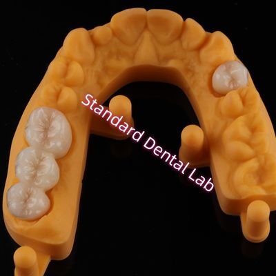 Crown All Porcelana Cerâmica Zirconia Ivoclar Dentes Estéticos OEM