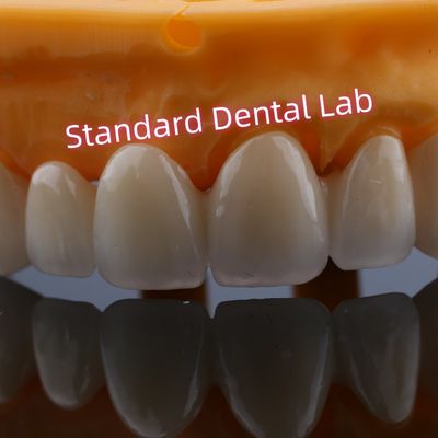 Restauração anterior Coroas de ponte de zircônio para dentes perdidos