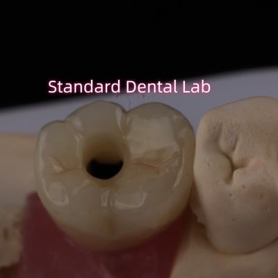 Implantação posterior Crown Bruxier Solid Zirconia parafuso retido