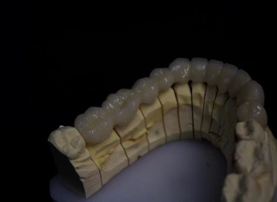 Porcelana em camadas, zircônio fundido