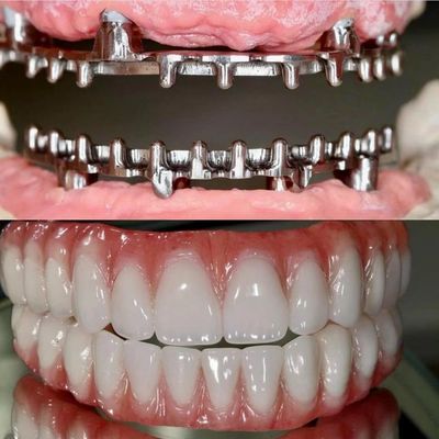 Dental Hybird Malo Implant Bridge Professional Perfect Fit Certificado pela FDA