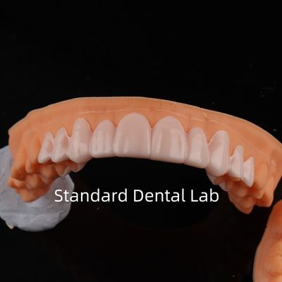 Alta Estética Dental Snap On Smile Standard Dental Lab