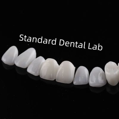 Dentes de alta estética Emax Veneers laminados Translucidez incisiva