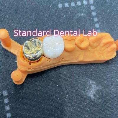 Coroa de liga de metal amarelo não precioso com coroa de zircônio
