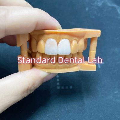 Alta estabilidade da cor Ivoclar Emax Veneers laminados Alta translucidez