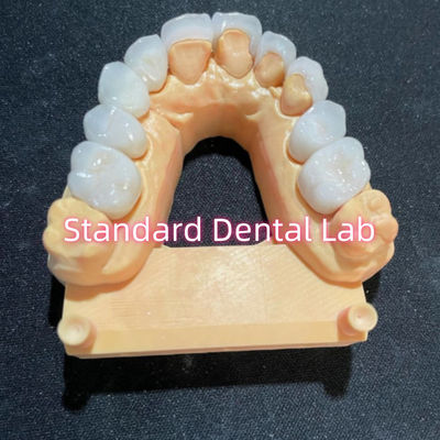 High Esthetic Hollywood Smile Milling Emax Veneers laminados