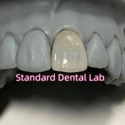 Dentologia Restaurativa Emax Circônio Dental Coronas de Porcelana