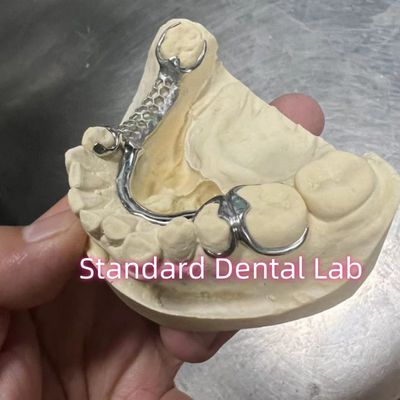Esqueleto Cromo Cast Dentura Parcial Quadro de Metal ISO