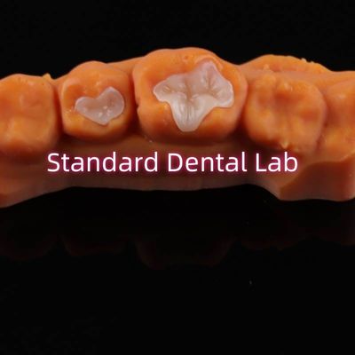 Porcelana Dental Inlay Onlay Overlay Zirconia Emax Composto Para Dentes em Carie