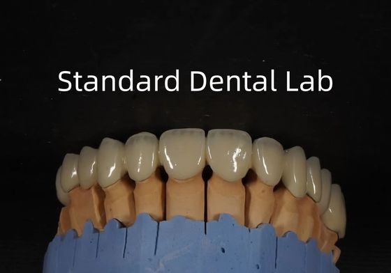 China Dental Lab Metal Coroa Cerâmica PFM Coroa Alta Estética