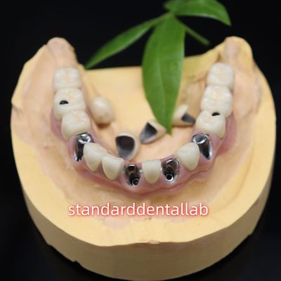 Implantes dentários retidos por parafuso coroas metálicas cerâmicas ponte Malo