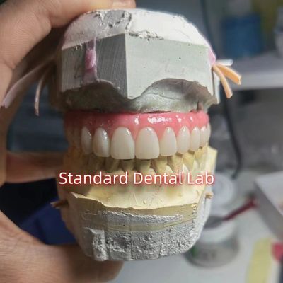 Parafusos retidos de titânio PMMA ponte dental coroa temporária