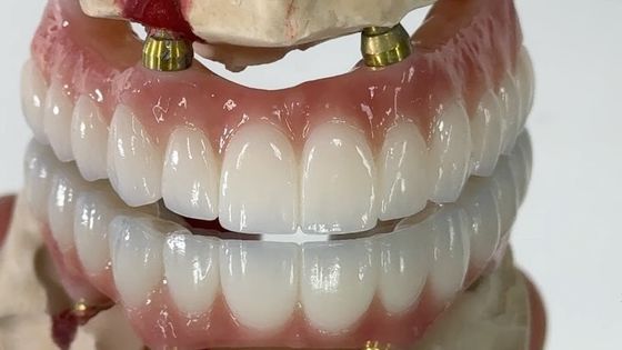 Dentário All On X Implante PFM Corona Titânio Fixado Dentadura Híbrida