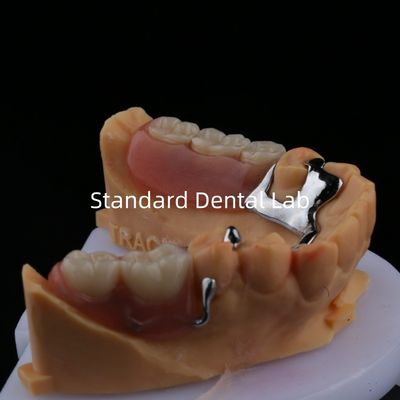 Quadro de Dentadura Parcial de Metal de Ligação 3 Forma Impressão a Laser Exocad Final parcial de fundição inferior