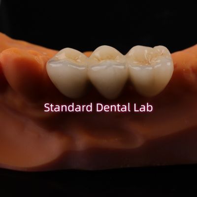 Coroas digitais de laboratório dental CAD CAM Coroa de zircônio translúcida em camadas