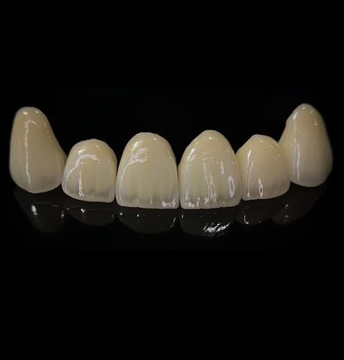 Confortável coroa de zircônio com bom ajuste e estética de precisão