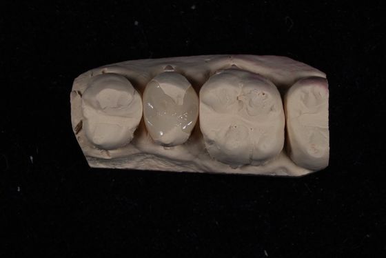 Força Emax Coroa de folheados cerâmicos com excelente resistência a manchas / biocompatibilidade